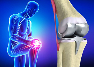 Kalça ve Diz Protezleri - Doç. Dr. Zafer SOYDAN