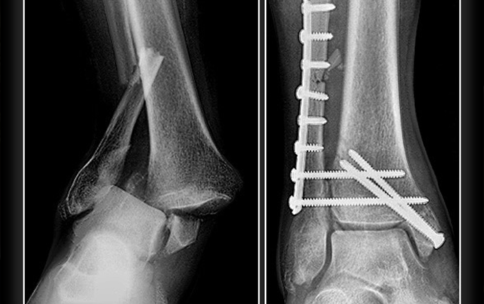 Kırık Çıkık Tedavisi