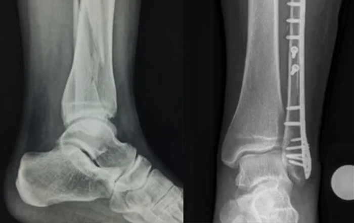 Ortopedik Travmalar ve Acil Cerrahi Tedavisi - Doç. Dr. Zafer SOYDAN