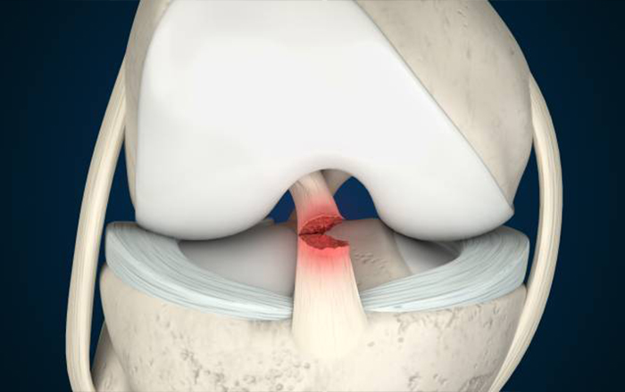 Spor Yaralanmalarının Tedavisi - Doç. Dr. Zafer SOYDAN